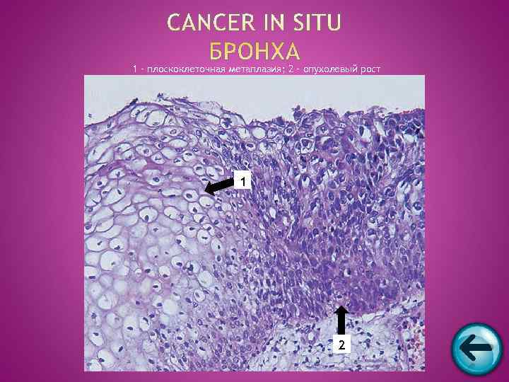 1 – плоскоклеточная метаплазия; 2 – опухолевый рост     1 