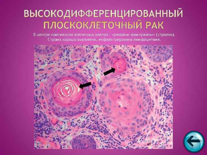 В центре комплексов атипичных клеток - «раковые жемчужины» (стрелка).   Строма хорошо выражена,