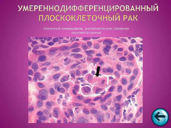 Клеточный плеоморфизм, внутриклеточные скопления    кератина (стрелка) 
