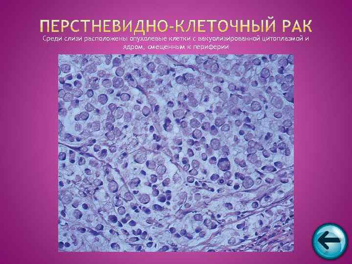 Среди слизи расположены опухолевые клетки с вакуолизированной цитоплазмой и    ядром, смещенным