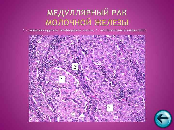 1 - скопления крупных полиморфных клеток; 2 – воспалительный инфильтрат    