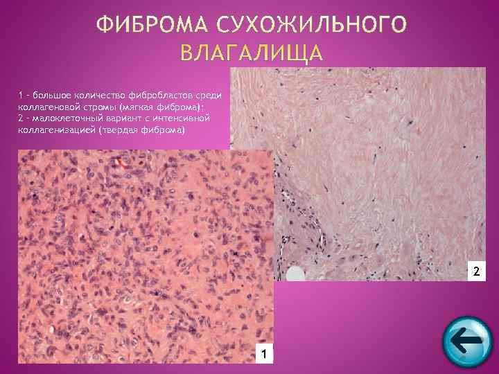 1 – большое количество фибробластов среди коллагеновой стромы (мягкая фиброма); 2 – малоклеточный вариант