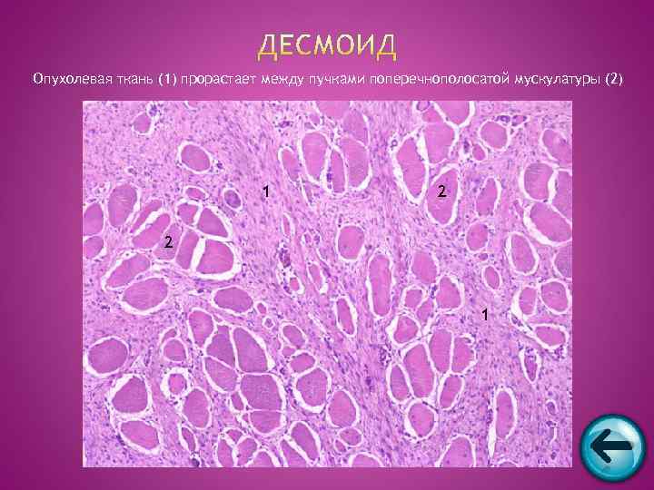 Опухолевая ткань (1) прорастает между пучками поперечнополосатой мускулатуры (2)     