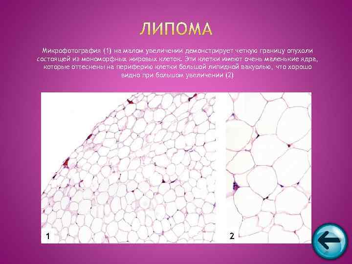  Микрофотография (1) на малом увеличении демонстрирует четкую границу опухоли состоящей из мономорфных жировых