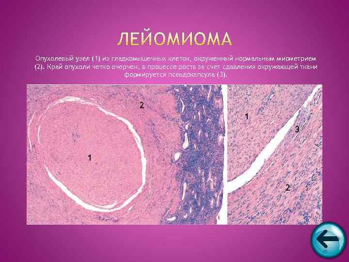  Опухолевый узел (1) из гладкомышечных клеток, окруженный нормальным миометрием (2). Край опухоли четко