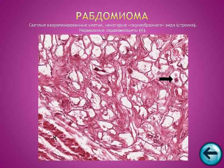 Светлые вакуолизированные клетки, некоторые «паукообразного» вида (стрелка).    Нормальные кардиомиоциты (К). 