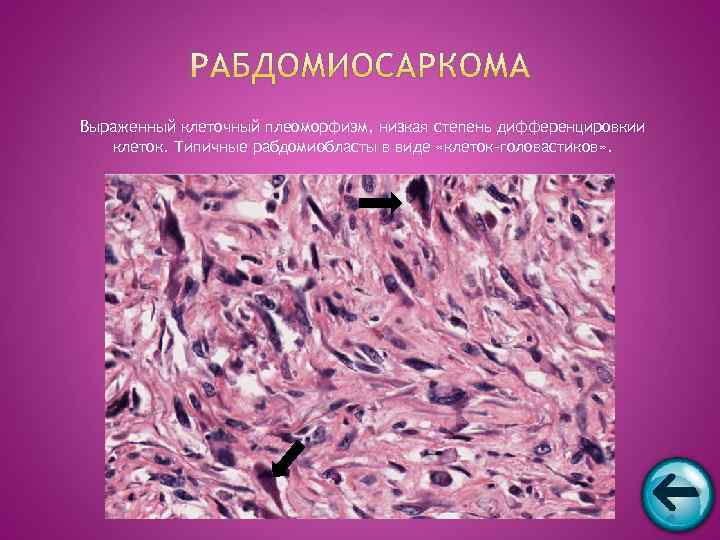 Выраженный клеточный плеоморфизм, низкая степень дифференцировкии  клеток. Типичные рабдомиобласты в виде «клеток-головастиков» .