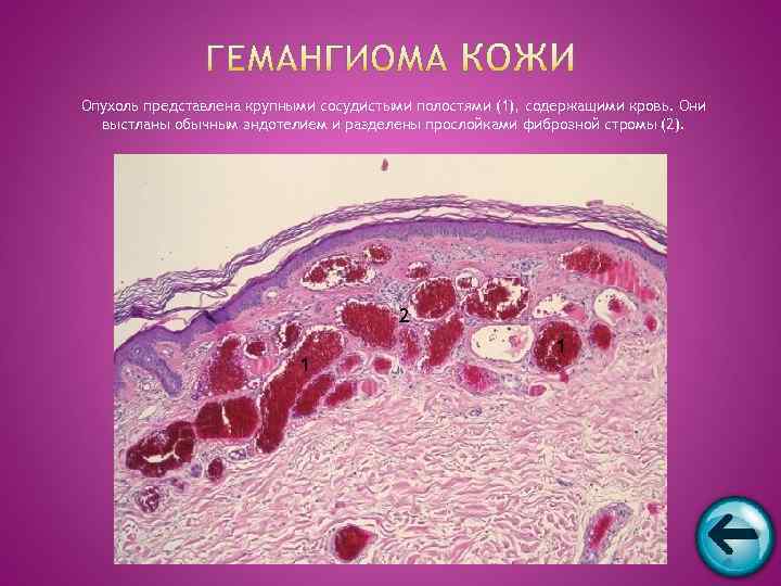 Опухоль представлена крупными сосудистыми полостями (1), содержащими кровь. Они  выстланы обычным эндотелием и
