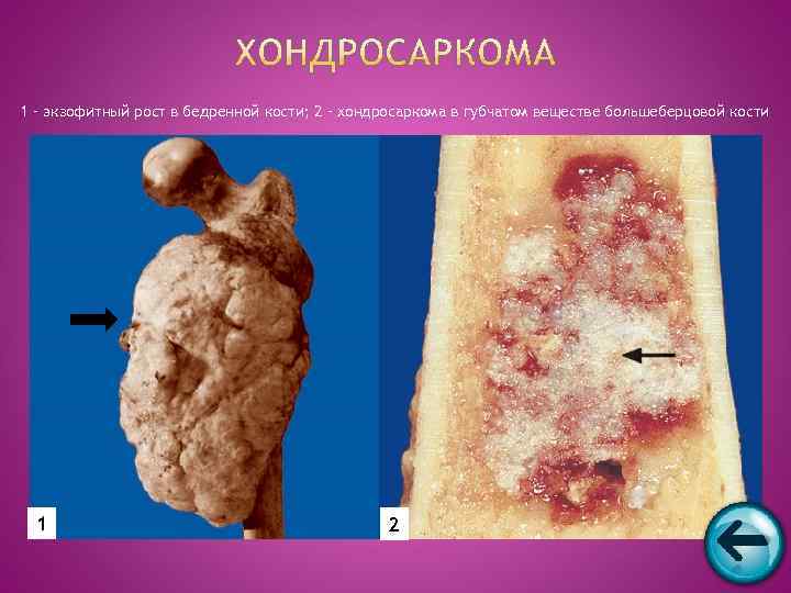 1 – экзофитный рост в бедренной кости; 2 – хондросаркома в губчатом веществе большеберцовой