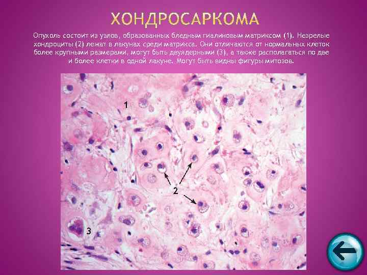 Опухоль состоит из узлов, образованных бледным гиалиновым матриксом (1). Незрелые хондроциты (2) лежат в