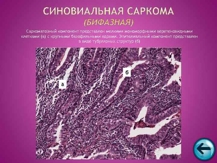  Саркоматозный компонент представлен мелкими мономорфными веретеновидными клетками (а) с крупными базофильными ядрами. Эпителиальный