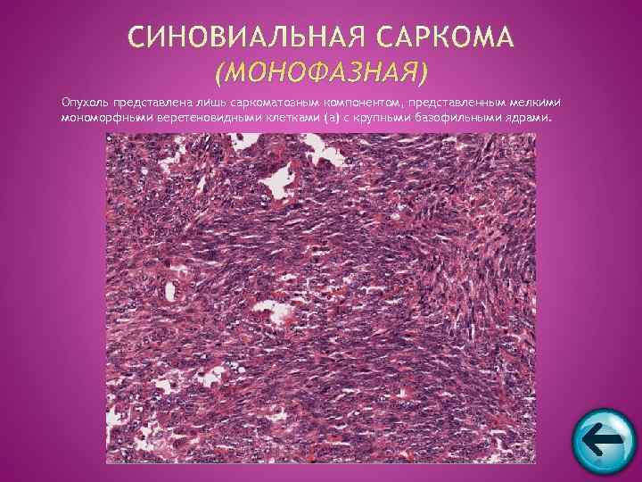 Опухоль представлена лишь саркоматозным компонентом, представленным мелкими мономорфными веретеновидными клетками (а) с крупными базофильными