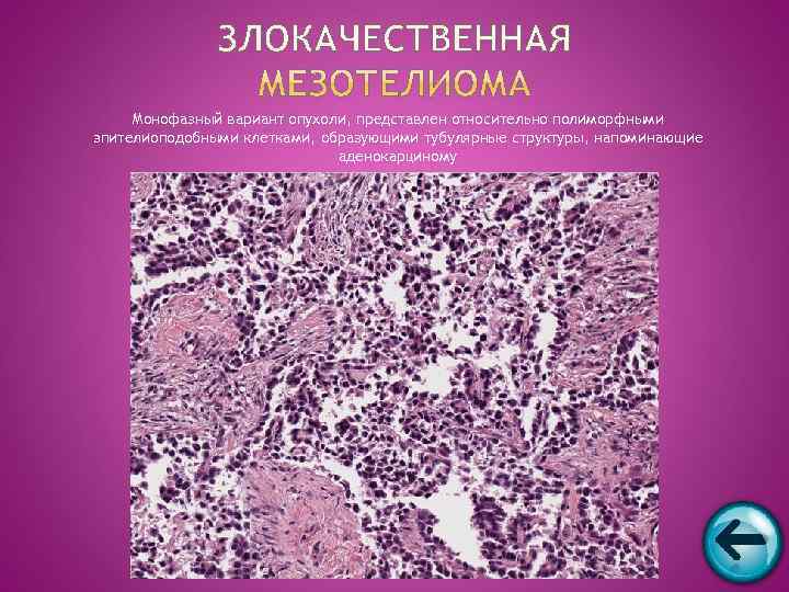  Монофазный вариант опухоли, представлен относительно полиморфными эпителиоподобными клетками, образующими тубулярные структуры, напоминающие 