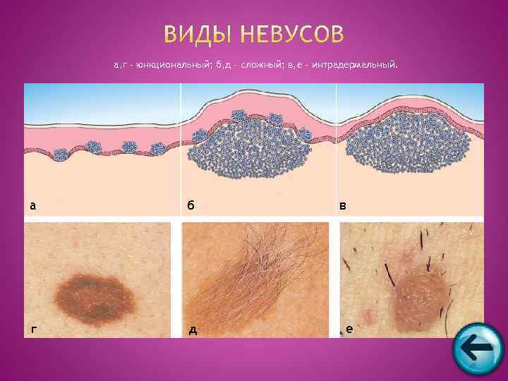   а, г – юнкциональный; б, д – сложный; в, е – интрадермальный.
