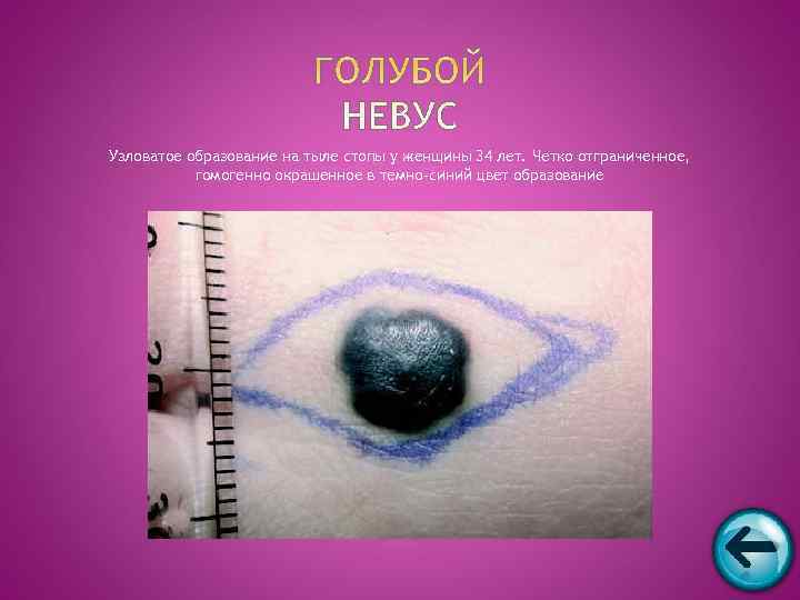 Узловатое образование на тыле стопы у женщины 34 лет. Четко отграниченное,   гомогенно