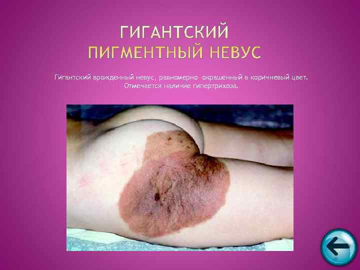 Гигантский врожденный невус, равномерно окрашенный в коричневый цвет.     Отмечается наличие