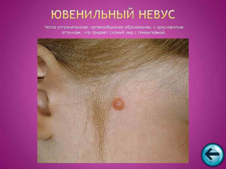 Четко отграниченное, куполообразное образование, с красноватым   оттенком, что придает схожий вид с