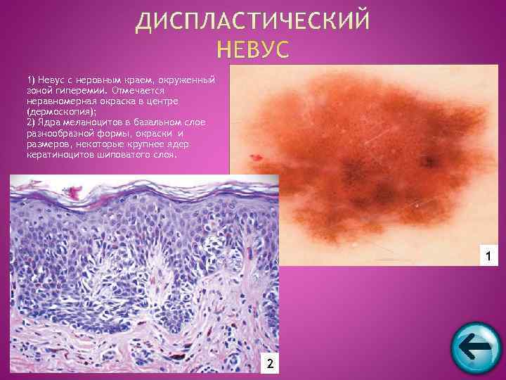 1) Невус с неровным краем, окруженный зоной гиперемии. Отмечается неравномерная окраска в центре (дермоскопия);