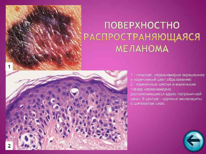 1 1 – плоское, неравномерно окрашенное в коричневый цвет образование; 2 – единичные клетки