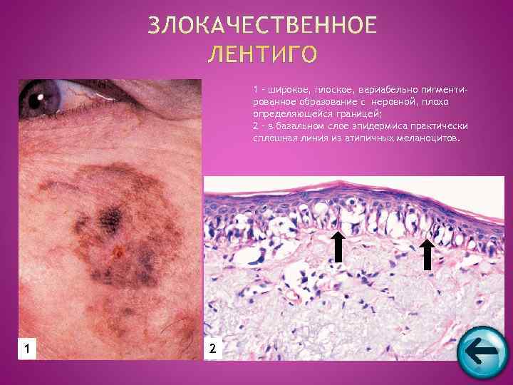   1 – широкое, плоское, вариабельно пигменти-   рованное образование с неровной,