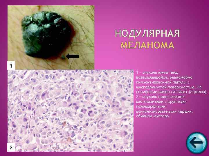1 1 – опухоль имеет вид возвышающейся, равномерно пигментированной папулы с многодольчатой поверхностью. На