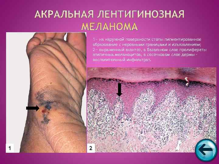   1 – на наружной поверхности стопы пигментированное   образование с неровными