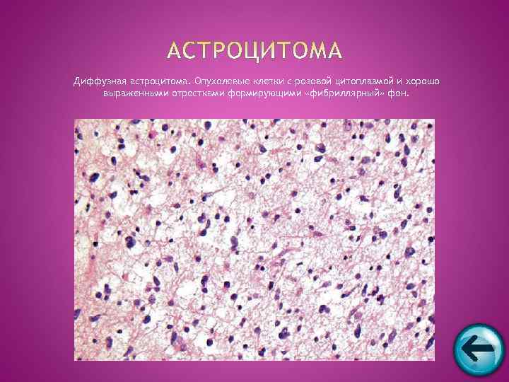 Диффузная астроцитома. Опухолевые клетки с розовой цитоплазмой и хорошо выраженными отростками формирующими «фибриллярный» фон.