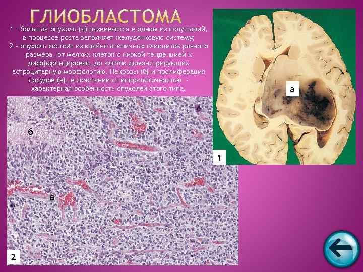 1 – большая опухоль (а) развивается в одном из полушарий,  в процессе роста