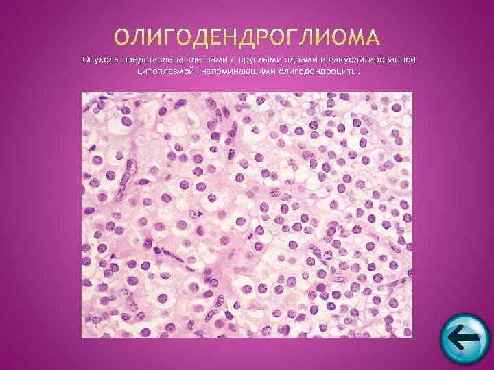 Опухоль представлена клетками с круглыми ядрами и вакуолизированной  цитоплазмой, напоминающими олигодендроциты. 
