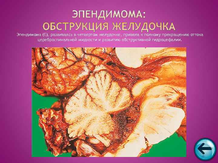 Эпендимома (E), развиваясь в четвертом желудочке, привела к полному прекращению оттока   цереброспинальной