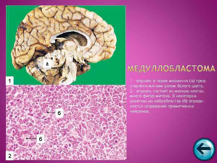   а  1 – опухоль в черве мозжечка (а) пред-  