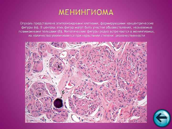  Опухоль представлена эпителиоидными клетками, формирующими концентрические  фигуры (а). В центрах этих фигур