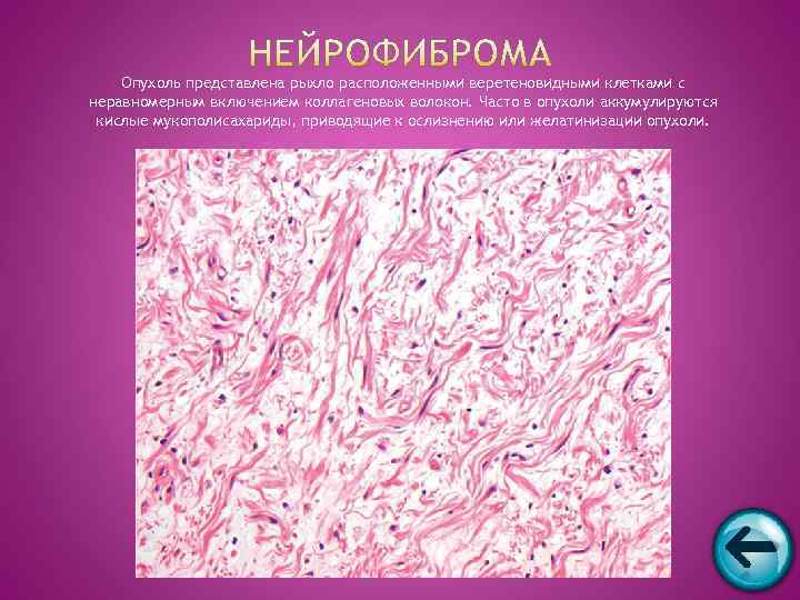   Опухоль представлена рыхло расположенными веретеновидными клетками с неравномерным включением коллагеновых волокон. Часто