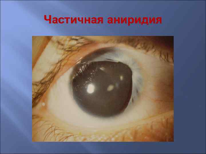 Кровоизлияние в переднюю камеру глаза фото