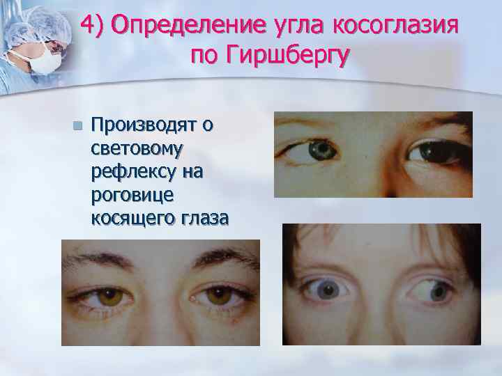 4) Определение угла косоглазия   по Гиршбергу n  Производят о световому рефлексу