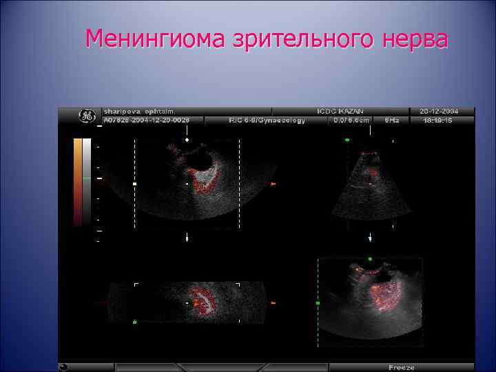 Менингиома зрительного нерва 