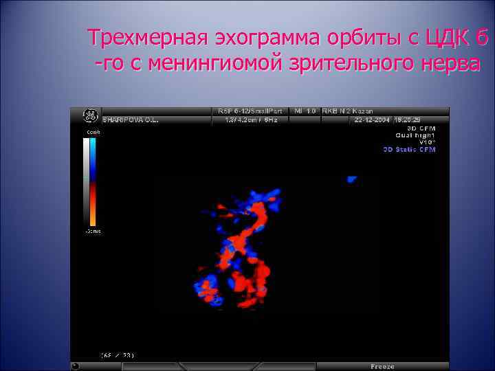 Трехмерная эхограмма орбиты с ЦДК б -го с менингиомой зрительного нерва 