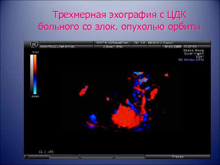   Трехмерная эхография с ЦДК больного со злок. опухолью орбиты 