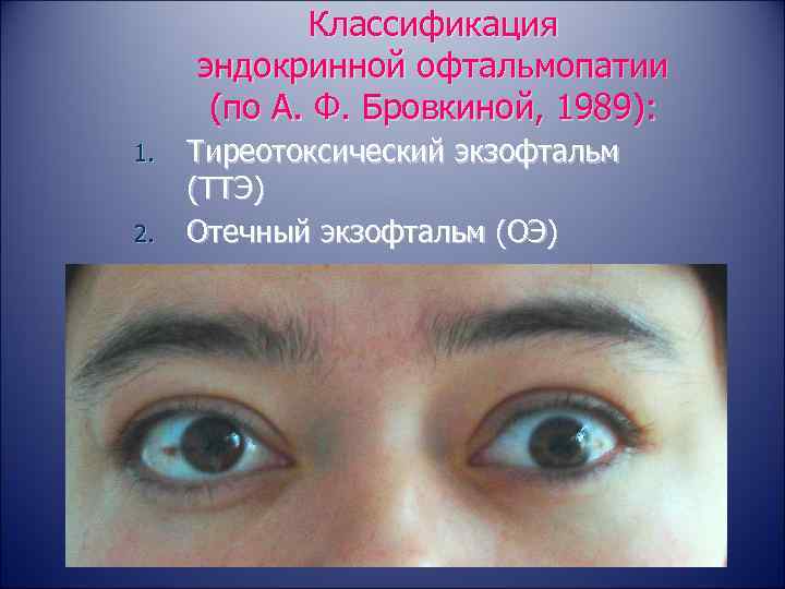   Классификация эндокринной офтальмопатии  (по А. Ф. Бровкиной, 1989): 1.  Тиреотоксический