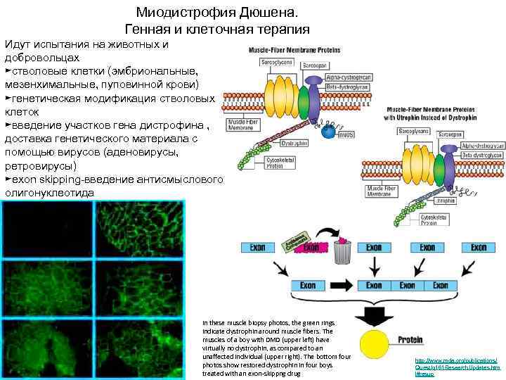 Миодистрофия дюшенна это. Диагностика миодистрофии Дюшенна. Патогенез миодистрофии Дюшенна. Миодистрофия Дюшенна этиология.