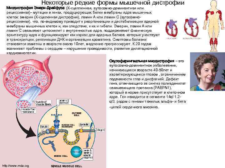      Некоторые редкие формы мышечной дистрофии  Миодистрофия Эмери-Дрейфуса (Х-сцепленная,