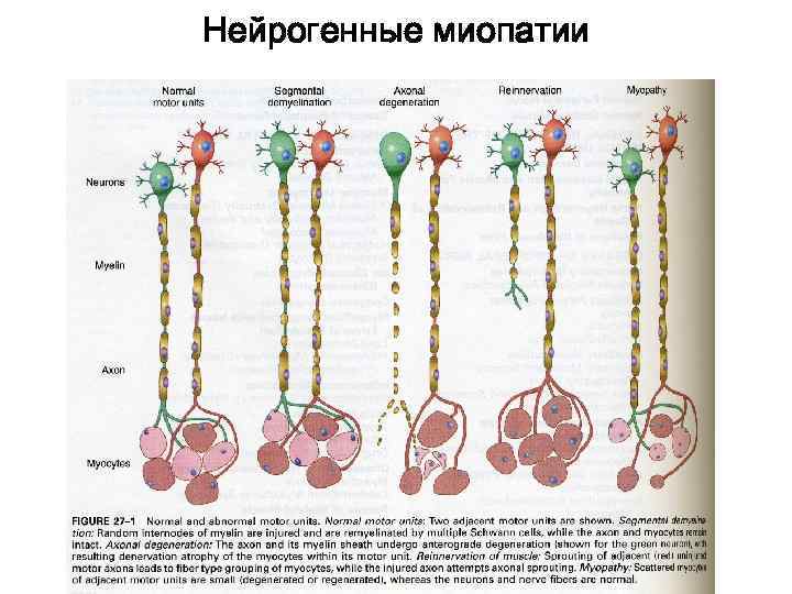 Нейрогенные миопатии 