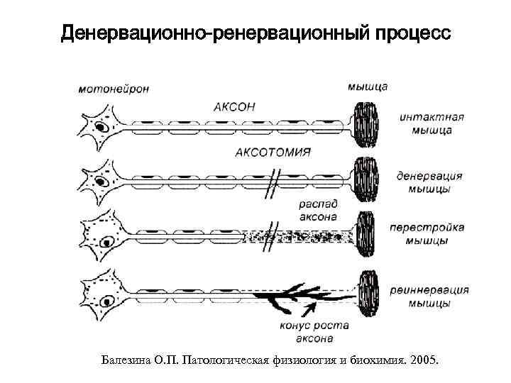 Денервационно-ренервационный процесс  Балезина О. П. Патологическая физиология и биохимия. 2005. 