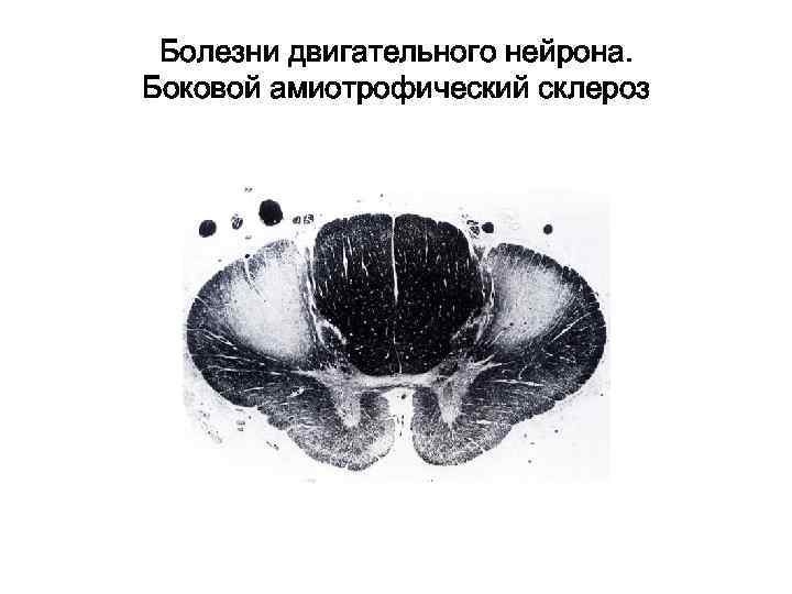  Болезни двигательного нейрона. Боковой амиотрофический склероз 