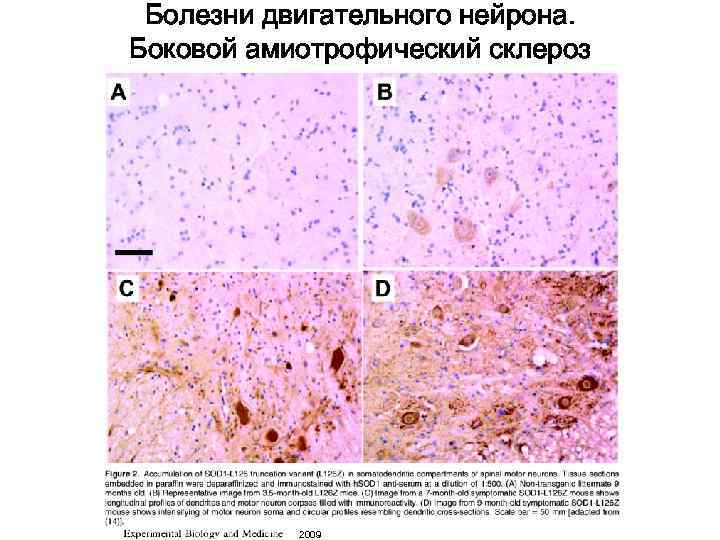  Болезни двигательного нейрона. Боковой амиотрофический склероз    2009 
