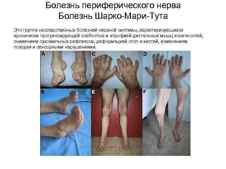   Болезнь периферического нерва    Болезнь Шарко-Мари-Тута Это группа наследственных болезней