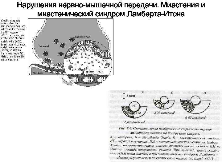 Нарушения нервно-мышечной передачи. Миастения и миастенический синдром Ламберта-Итона 
