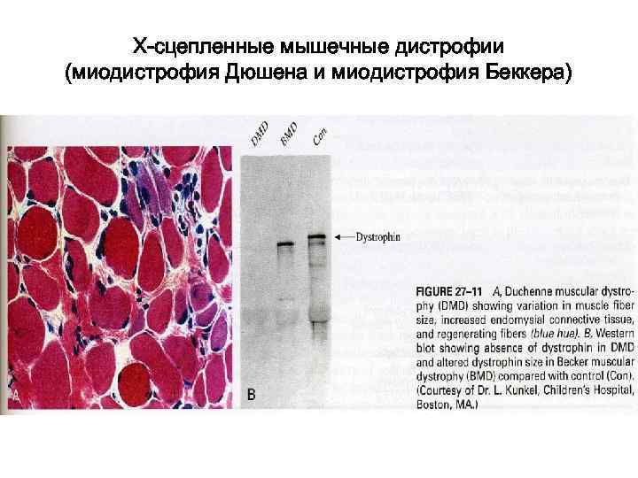  Х-сцепленные мышечные дистрофии (миодистрофия Дюшена и миодистрофия Беккера) 