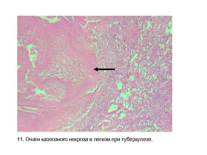 11. Очаги казеозного некроза в легком при туберкулезе. 