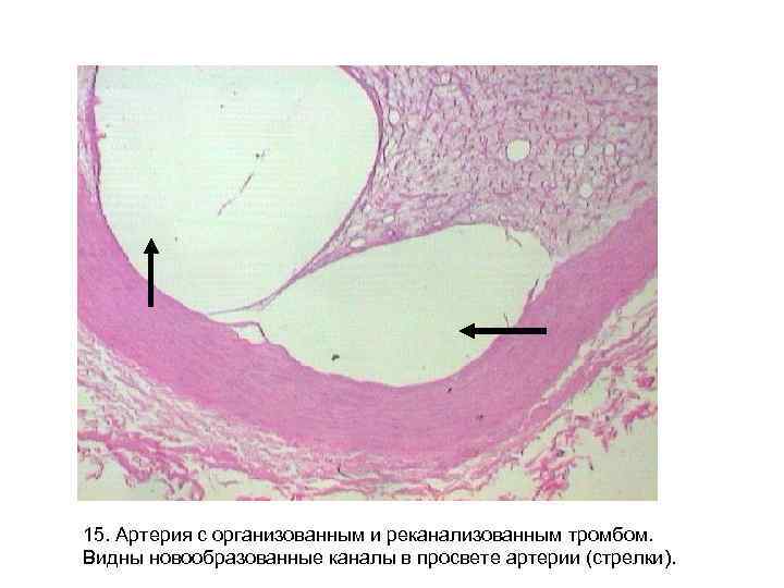 15. Артерия с организованным и реканализованным тромбом. Видны новообразованные каналы в просвете артерии (стрелки).